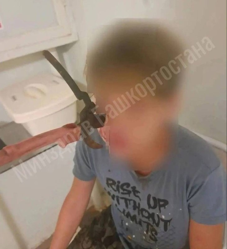 Подросток в Башкирии пострадал от секатора во время игры