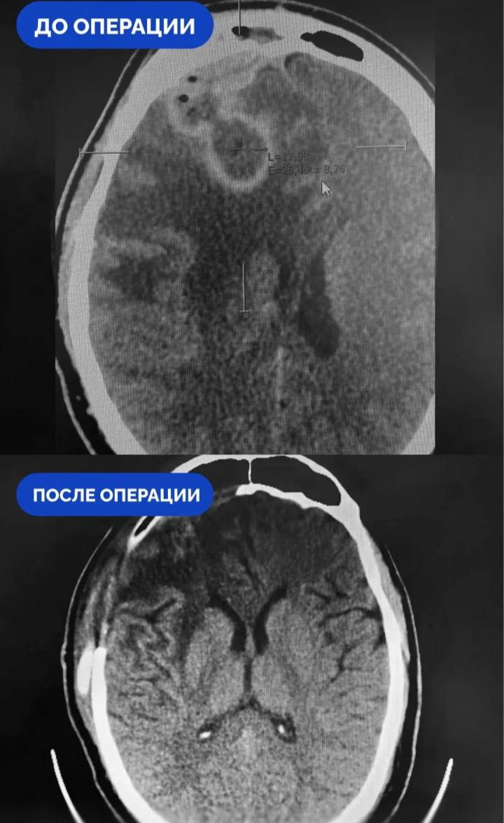 Самолечение насморка привело к абсцессу мозга у жителя Сургута