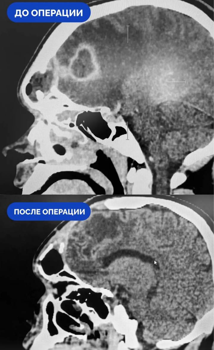 Самолечение насморка привело к абсцессу мозга у жителя Сургута